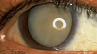 eye-cataract