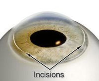 Diagram of where the limbal relaxing incisions are placed on the eye
