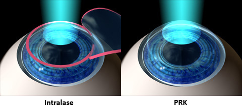 Diagram of two eyes showing the difference between iLASIK (Intralase) and PRK