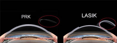Diagram showing the flap with LASIK vs. how it looks for PRK