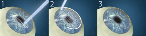 Diagram showing three eyeballs and each step of Intralase